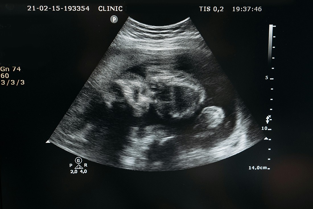 An ultrasound photo shows a developing child in its mother’s uterus. Stock photo/Pexels