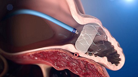 Watchman implant helps to reduce risk of blood clots, stroke
